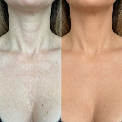 SkinPerfect™